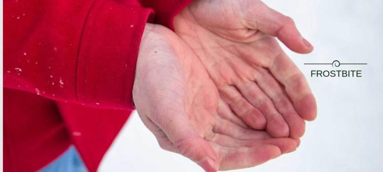 Frostbite or Cold Injury, a Common but Fatal Disease